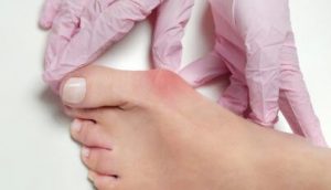 Hallux valgus, bunion in foot stock photo