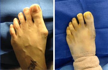 patient feet before and after